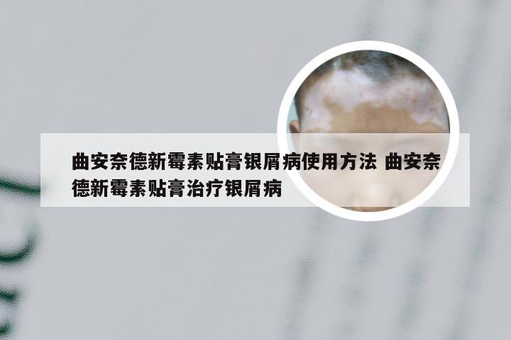 曲安奈德新霉素贴膏银屑病使用方法 曲安奈德新霉素贴膏治疗银屑病