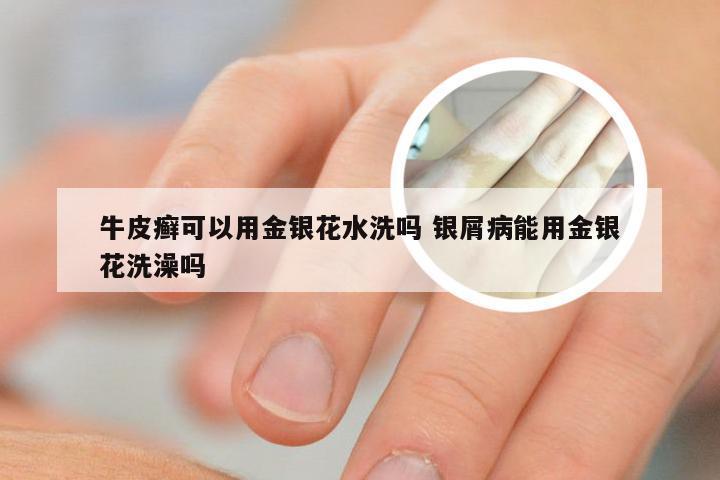 牛皮癣可以用金银花水洗吗 银屑病能用金银花洗澡吗