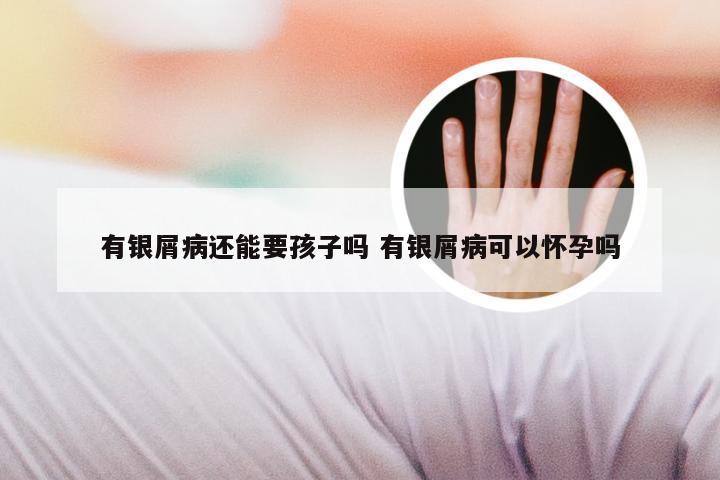 有银屑病还能要孩子吗 有银屑病可以怀孕吗