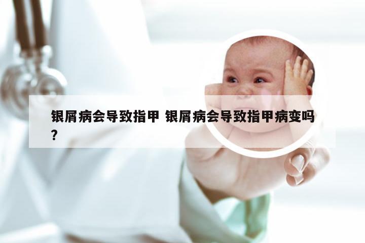 银屑病会导致指甲 银屑病会导致指甲病变吗?