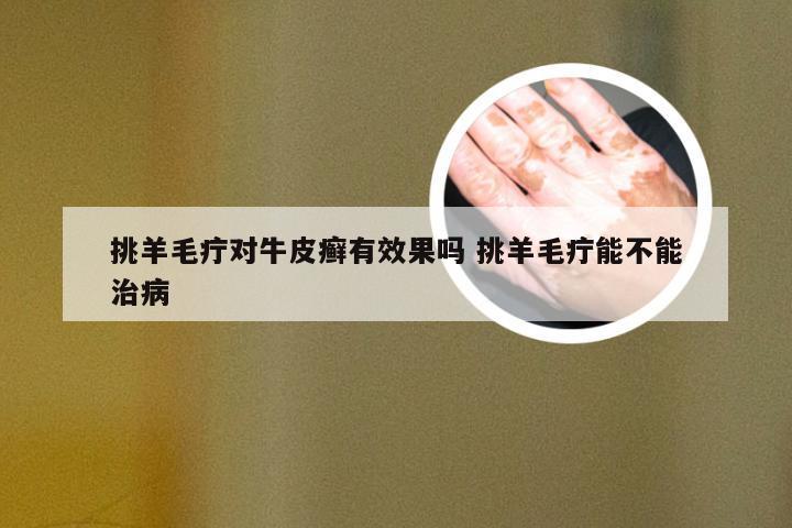 挑羊毛疔对牛皮癣有效果吗 挑羊毛疔能不能治病