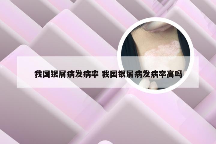 我国银屑病发病率 我国银屑病发病率高吗