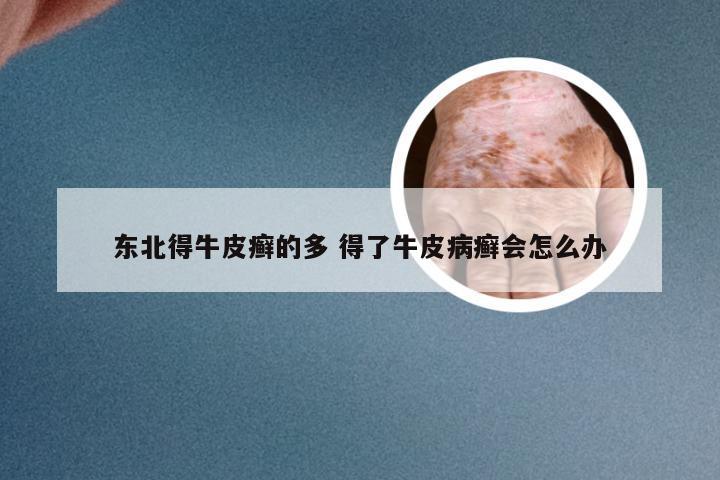 东北得牛皮癣的多 得了牛皮病癣会怎么办