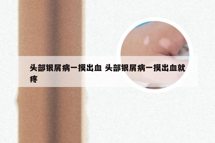 头部银屑病一摸出血 头部银屑病一摸出血就疼