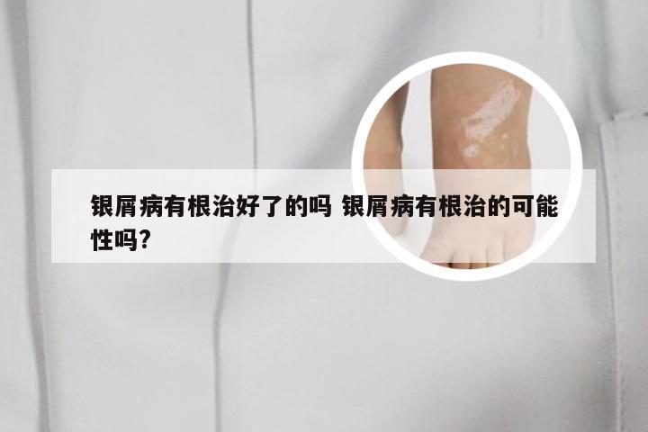 银屑病有根治好了的吗 银屑病有根治的可能性吗?