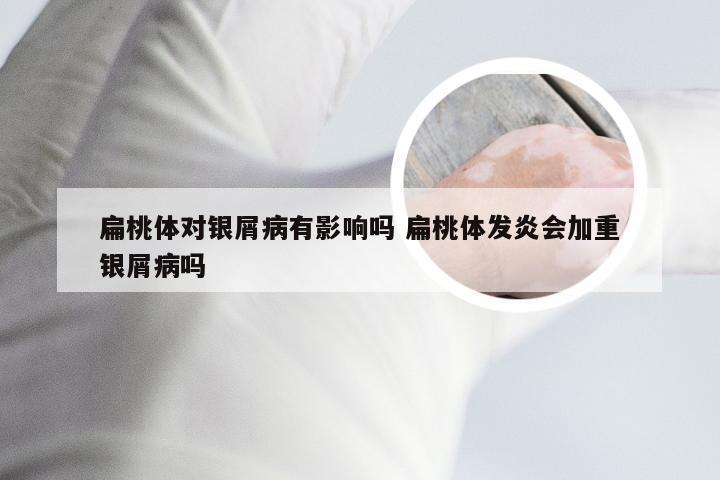 扁桃体对银屑病有影响吗 扁桃体发炎会加重银屑病吗