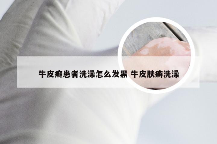 牛皮癣患者洗澡怎么发黑 牛皮肤癣洗澡
