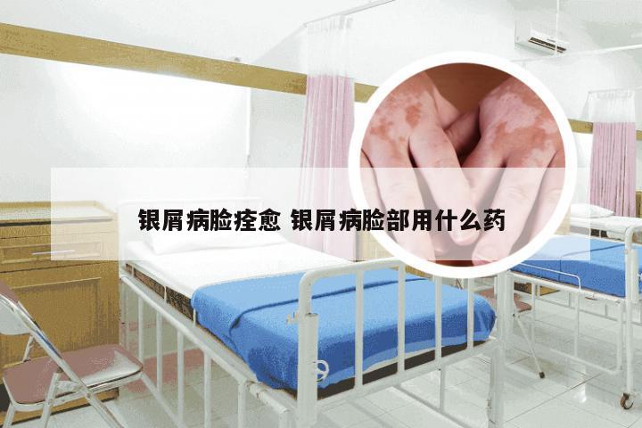 银屑病脸痊愈 银屑病脸部用什么药
