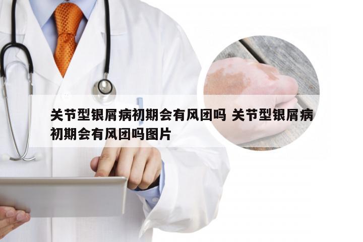关节型银屑病初期会有风团吗 关节型银屑病初期会有风团吗图片