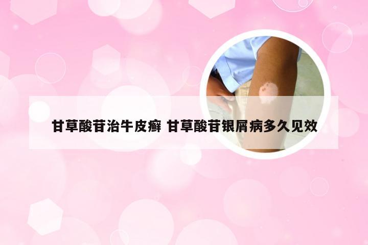 甘草酸苷治牛皮癣 甘草酸苷银屑病多久见效