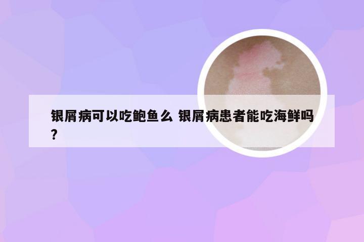 银屑病可以吃鲍鱼么 银屑病患者能吃海鲜吗?