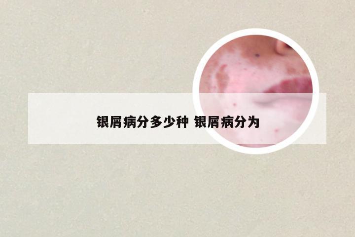 银屑病分多少种 银屑病分为