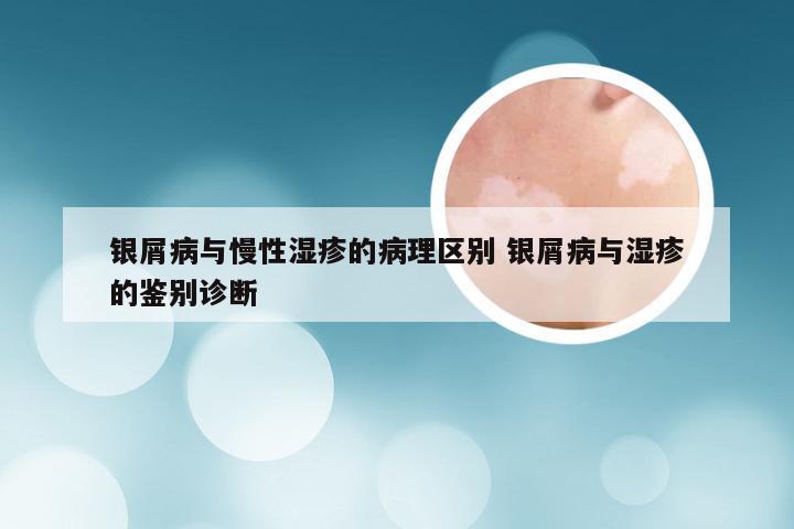 银屑病与慢性湿疹的病理区别 银屑病与湿疹的鉴别诊断
