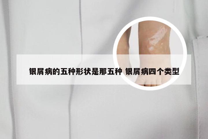银屑病的五种形状是那五种 银屑病四个类型
