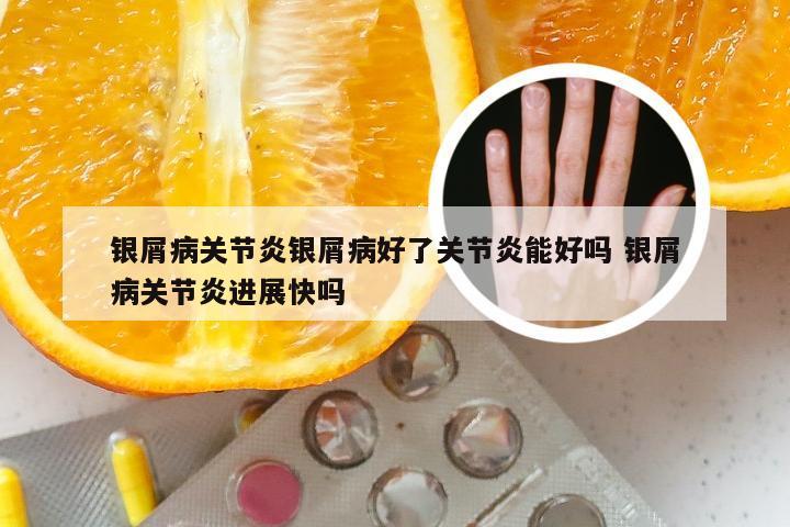 银屑病关节炎银屑病好了关节炎能好吗 银屑病关节炎进展快吗