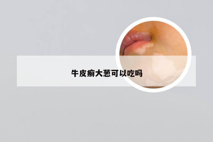 牛皮癣大葱可以吃吗