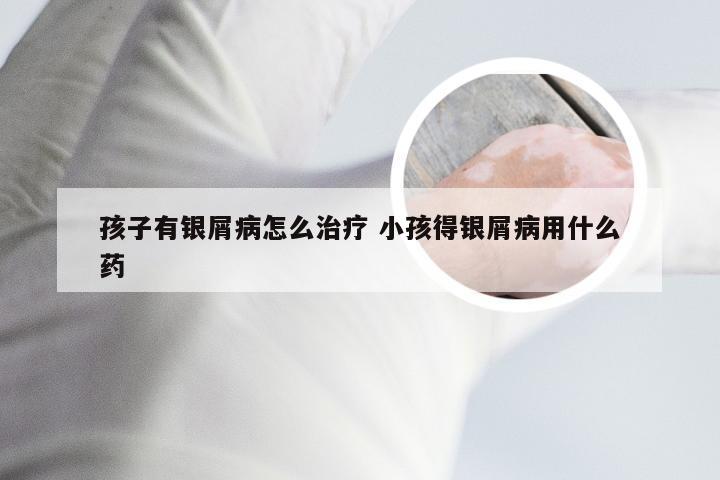 孩子有银屑病怎么治疗 小孩得银屑病用什么药