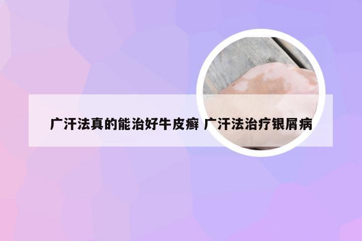 广汗法真的能治好牛皮癣 广汗法治疗银屑病