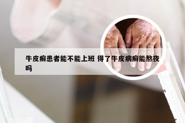 牛皮癣患者能不能上班 得了牛皮病癣能熬夜吗