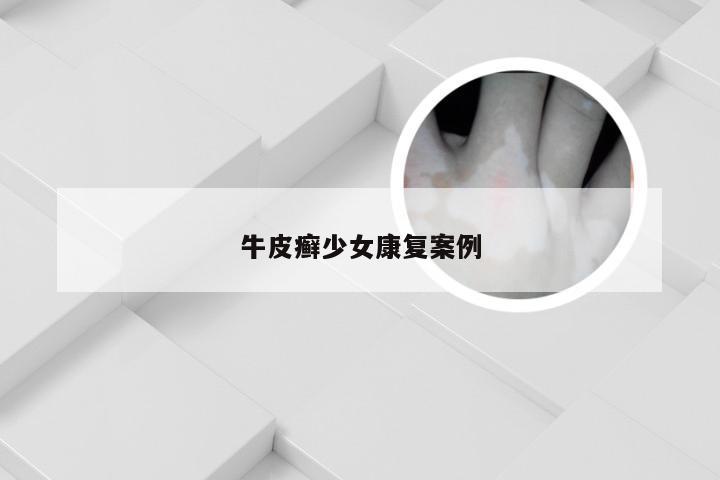 牛皮癣少女康复案例