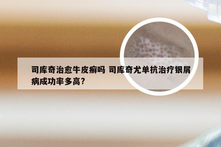 司库奇治愈牛皮癣吗 司库奇尤单抗治疗银屑病成功率多高?