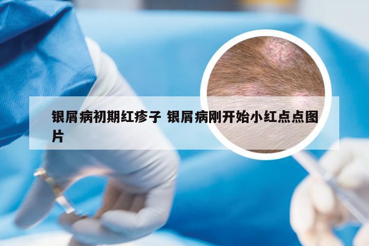 银屑病初期红疹子 银屑病刚开始小红点点图片