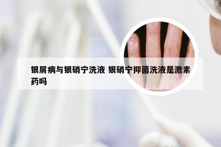 银屑病与银硝宁洗液 银硝宁抑菌洗液是激素药吗