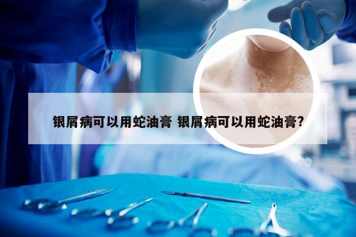 银屑病可以用蛇油膏 银屑病可以用蛇油膏?