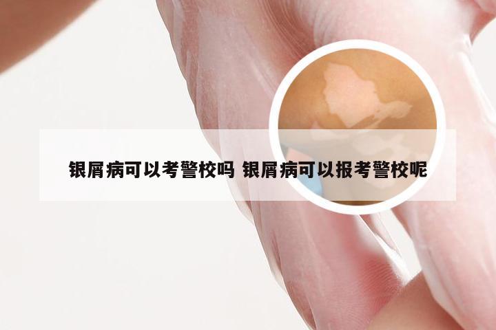 银屑病可以考警校吗 银屑病可以报考警校呢