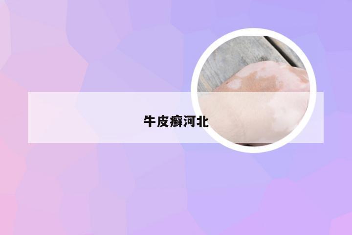 牛皮癣河北