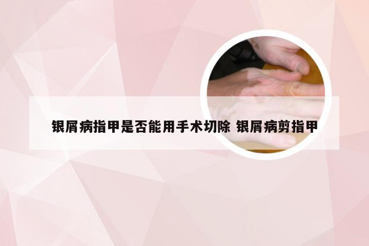 银屑病指甲是否能用手术切除 银屑病剪指甲