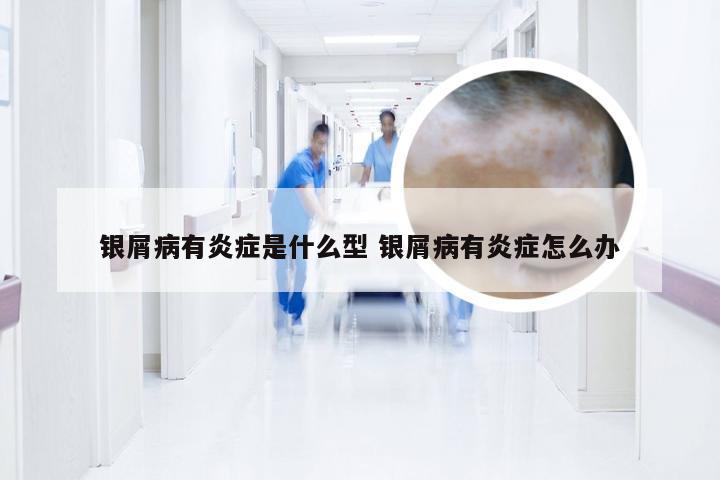 银屑病有炎症是什么型 银屑病有炎症怎么办