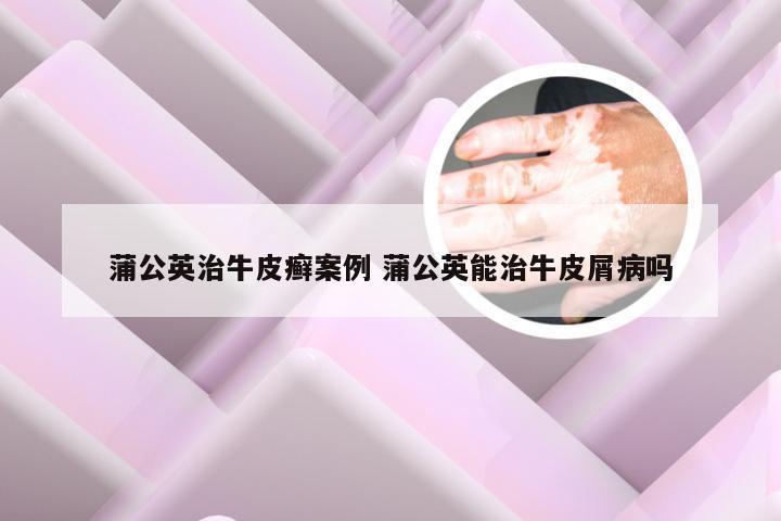 蒲公英治牛皮癣案例 蒲公英能治牛皮屑病吗