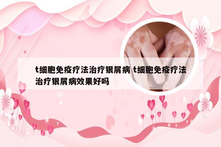 t细胞免疫疗法治疗银屑病 t细胞免疫疗法治疗银屑病效果好吗