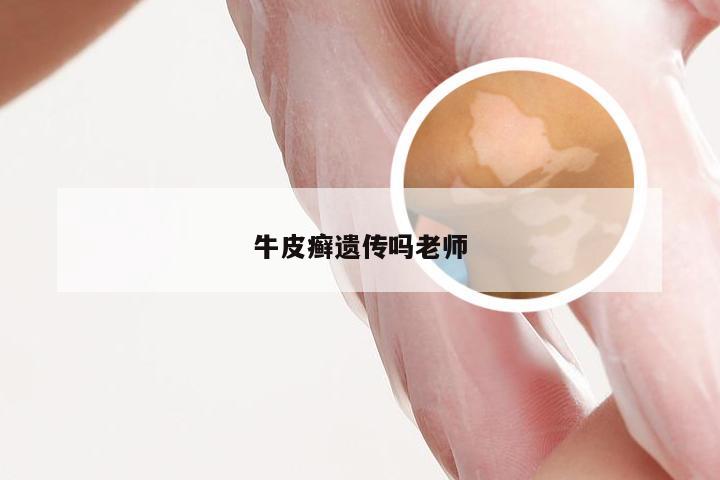 牛皮癣遗传吗老师