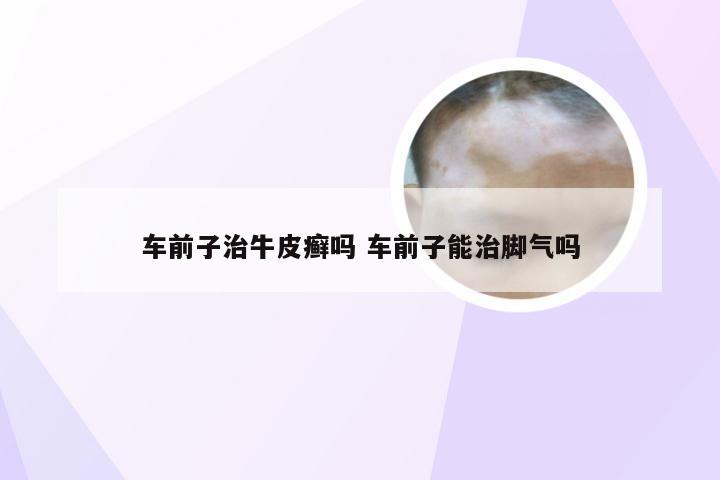 车前子治牛皮癣吗 车前子能治脚气吗