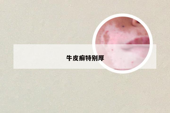 牛皮癣特别厚