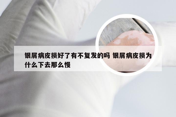 银屑病皮损好了有不复发的吗 银屑病皮损为什么下去那么慢