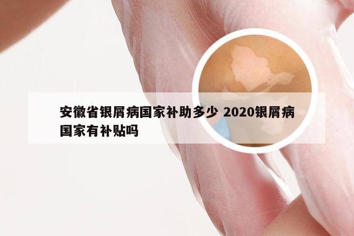 安徽省银屑病国家补助多少 2020银屑病国家有补贴吗