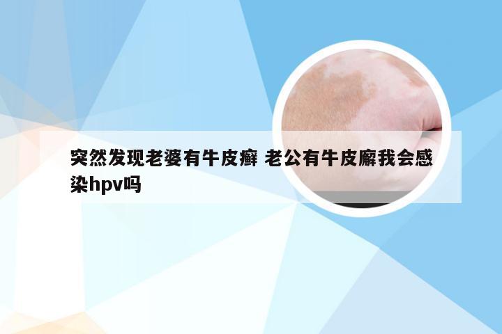突然发现老婆有牛皮癣 老公有牛皮廨我会感染hpv吗