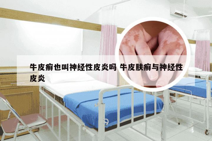 牛皮癣也叫神经性皮炎吗 牛皮肤癣与神经性皮炎