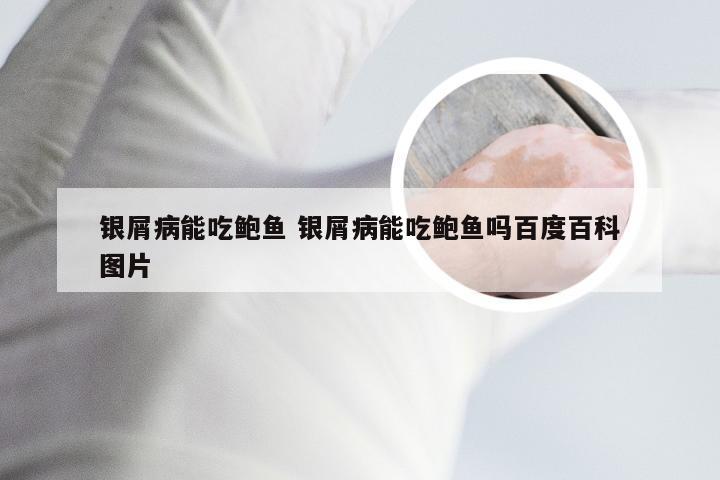 银屑病能吃鲍鱼 银屑病能吃鲍鱼吗百度百科图片