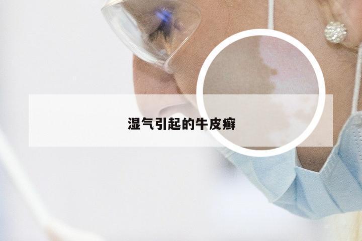 湿气引起的牛皮癣