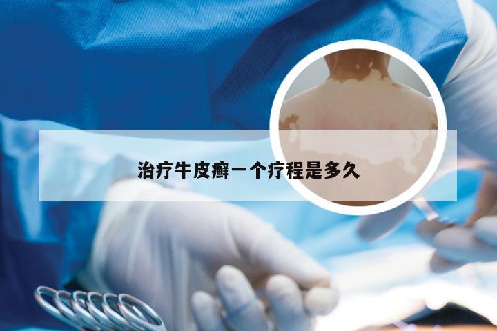 治疗牛皮癣一个疗程是多久