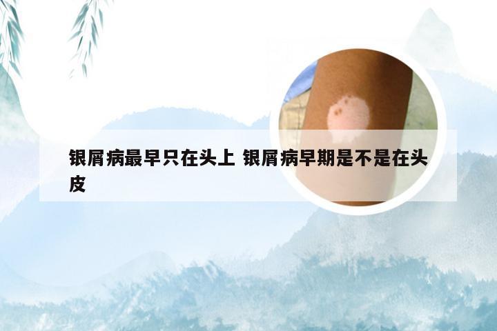 银屑病最早只在头上 银屑病早期是不是在头皮