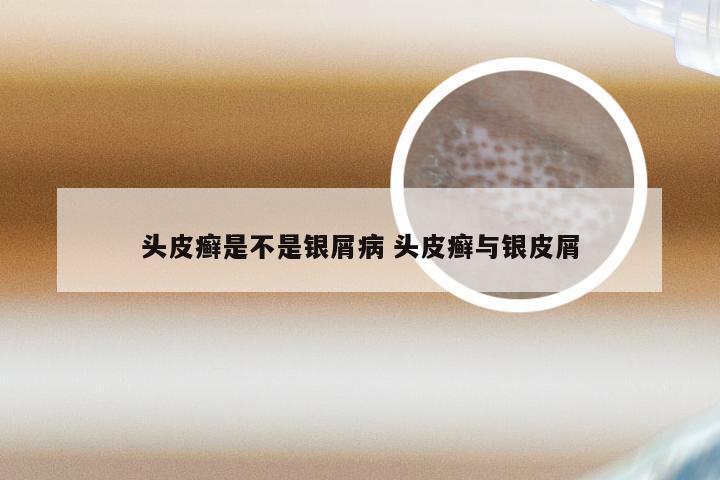 头皮癣是不是银屑病 头皮癣与银皮屑