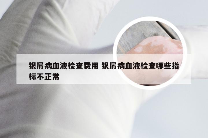 银屑病血液检查费用 银屑病血液检查哪些指标不正常