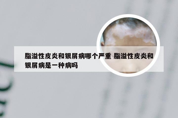 脂溢性皮炎和银屑病哪个严重 脂溢性皮炎和银屑病是一种病吗