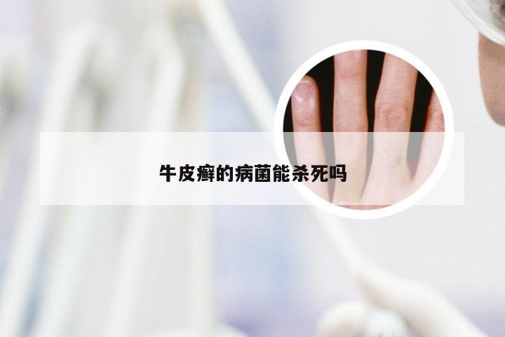 牛皮癣的病菌能杀死吗