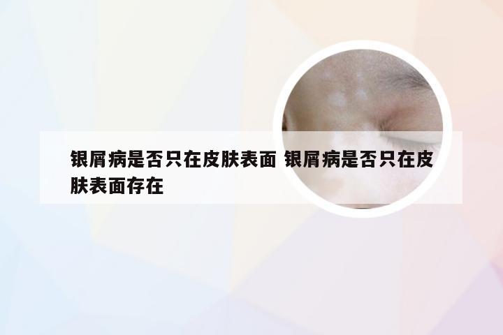 银屑病是否只在皮肤表面 银屑病是否只在皮肤表面存在